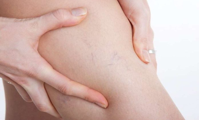 Does Venoxil relieve leg swelling and heaviness?