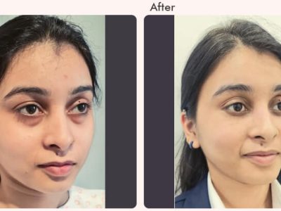 What is Single Eyelid or Double Eyelid Surgery?