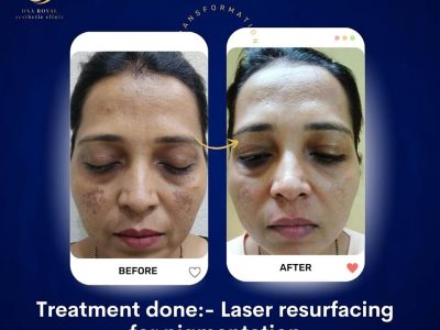 DNA Royal Aesthetic Clinic: Trusted for Laser Resurfacing Treatment in Thane.