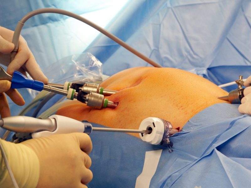 Laparoscopy Training in India