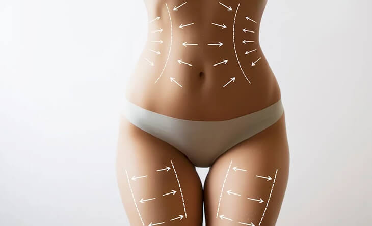 Tips to Maintain Better Results After Liposuction