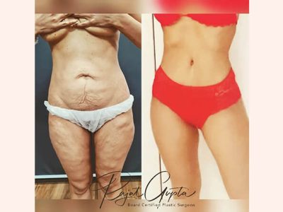 Tummy Tuck Surgery for Flat Belly That You Desire