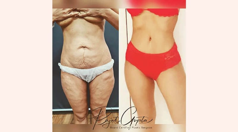 Tummy Tuck Surgery for Flat Belly That You Desire