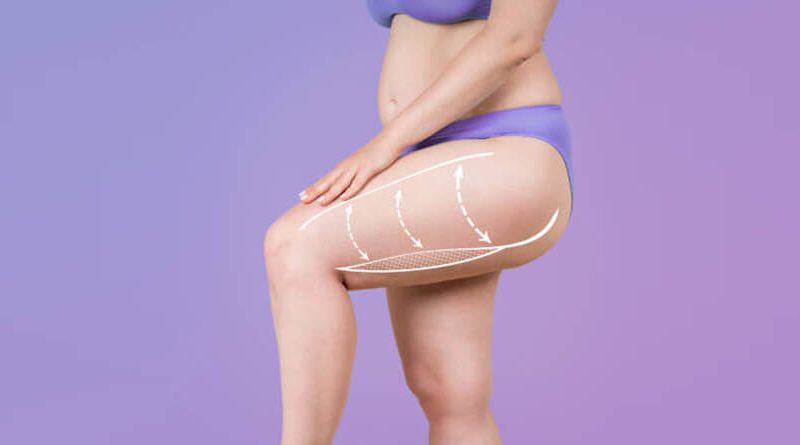 What Is a Thigh Lift Surgery?
