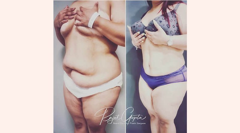 How Abdominoplasty Helps Flatten Your Tummy?