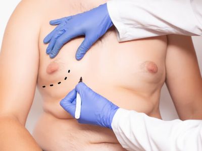 How to Get Gynecomastia Surgery Covered by Insurance?