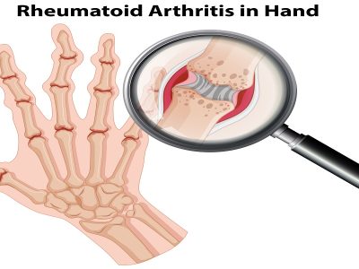 Natural Rheumatoid Arthritis Treatment at Nimba
