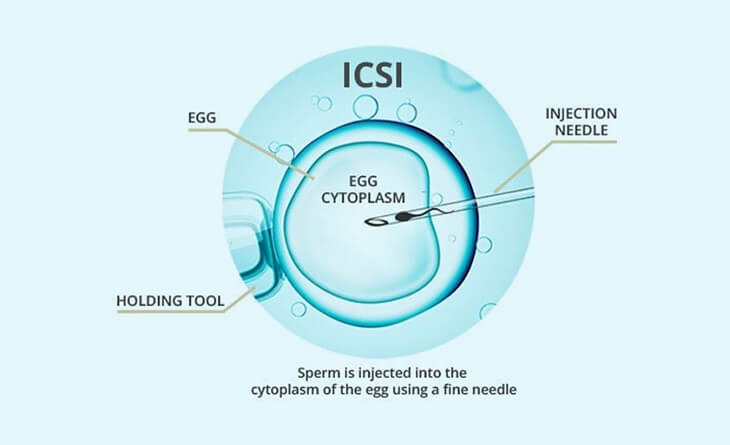 ICSI Treatment in Delhi - Dr Rhythm Gupta