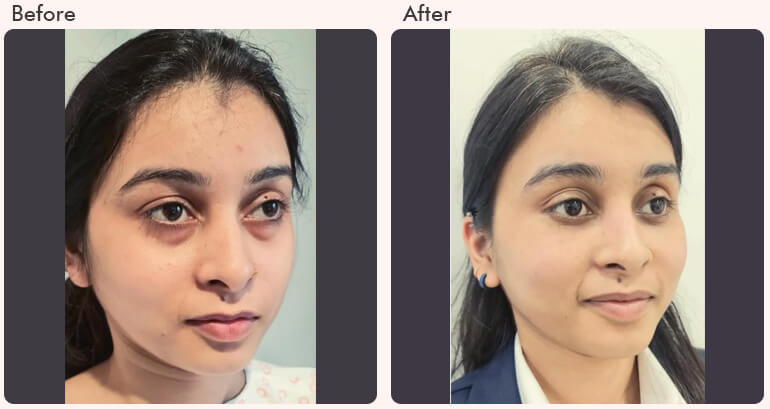 Getting Double Eyelids: Is Surgery Safe and Necessary?
