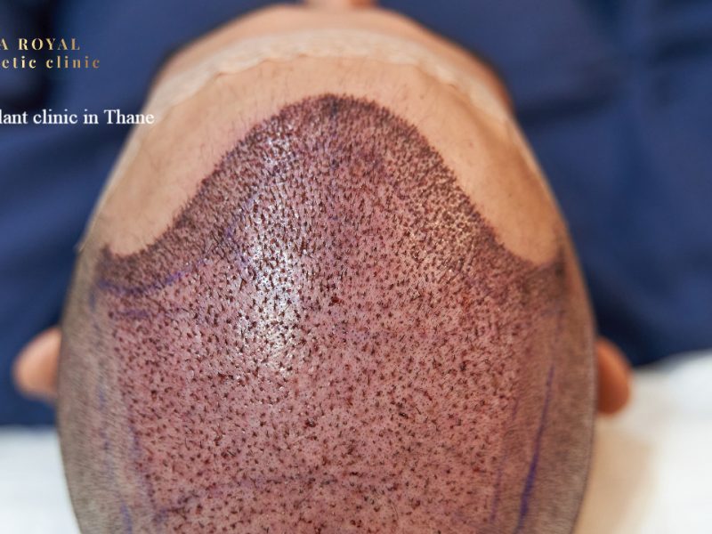 Thane’s Premier Hair Transplant Specialists – DNA Royal Aesthetic Clinic.