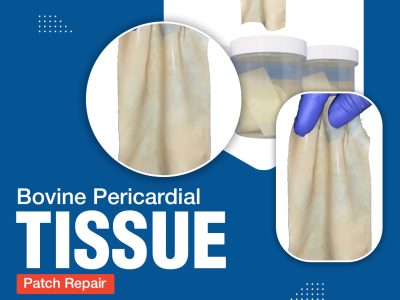 Bovine Pericardial Tissue Patch Repair