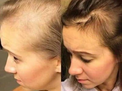 Best Hair Regrowth for Women in Thane | DNA Royal Clinic.