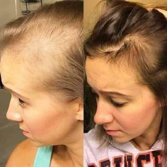 Best Hair Regrowth for Women in Thane | DNA Royal Clinic.