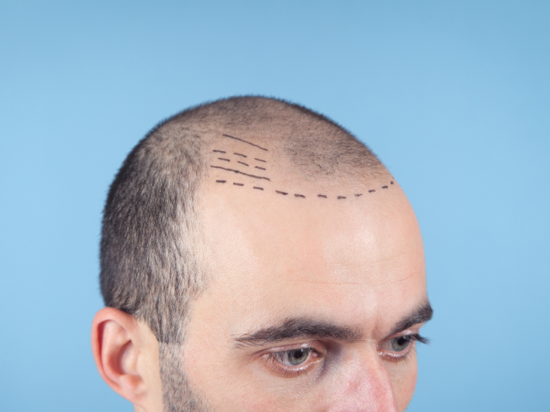 Affordable Hair Transplant Clinic in Thane | DNA Royal Aesthetic Clinic.