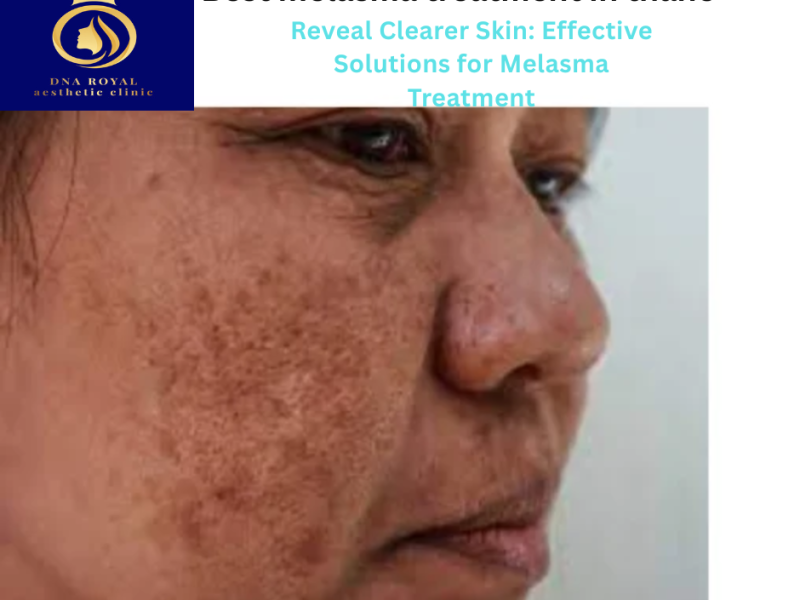 DNA Royal: Your Destination for the Best Melasma Treatment in Thane.