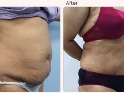 Liposuction Surgery Cost in Delhi - Dr Rajat Gupta