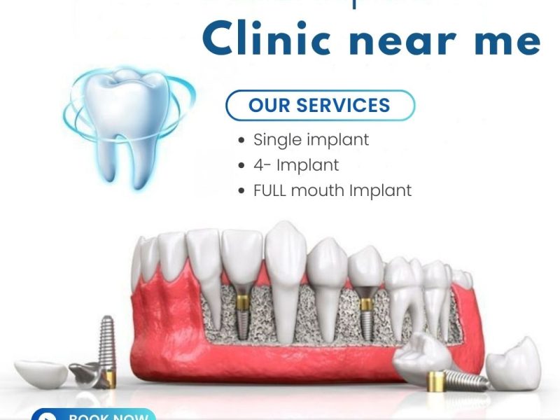 Dental implant clinic near me for reliable implant solutions