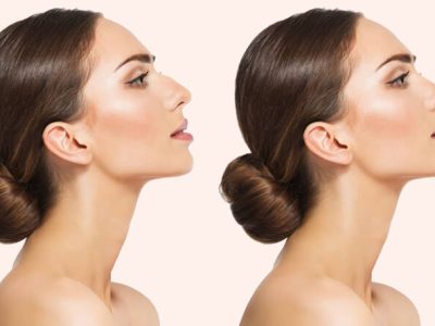 How Long Does a Nose Job Take to Heal?
