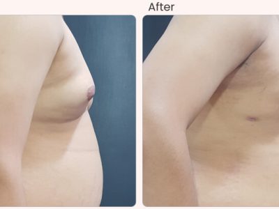 Gynecomastia Surgery in Delhi - Dr Rajat Gupta