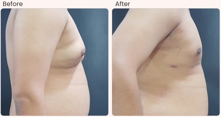 Gynecomastia Surgery in Delhi - Dr Rajat Gupta