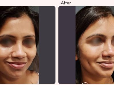 Dimple Creation Surgery Cost in Delhi - Dr Rajat Gupta