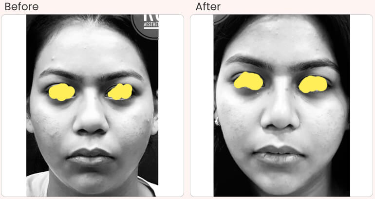Buccal Pad Fat Removal Surgery in Delhi - Dr Rajat Gupta