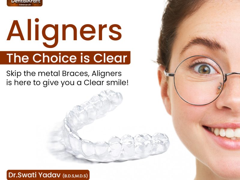 Aligners Treatment for Teeth Straightening in Indirapuram for Comfort