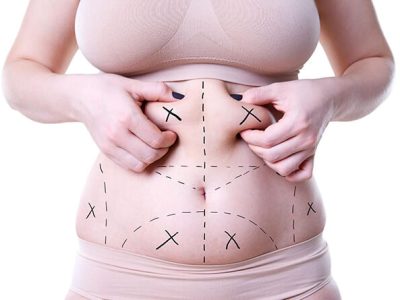 Can I Get Multiple Areas of Liposuction at Once?