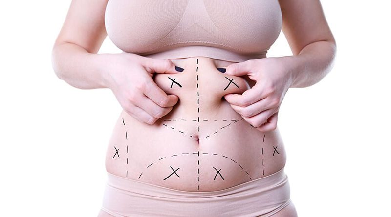 Can I Get Multiple Areas of Liposuction at Once?