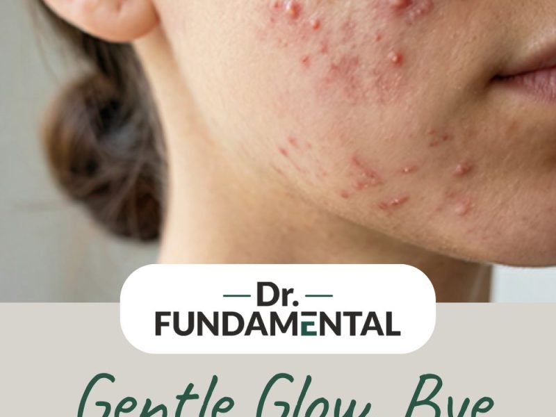 Gentle Glow, Bye Acne!