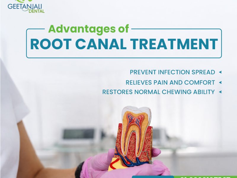 Root Canal Treatment in Gaur City for Safe Tooth Care