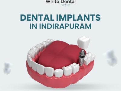 Trusted Dental Implants in Indirapuram for a Perfect Smile
