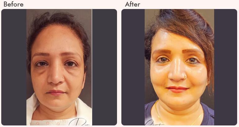Eyelid Surgery in Delhi - Dr Rajat Gupta