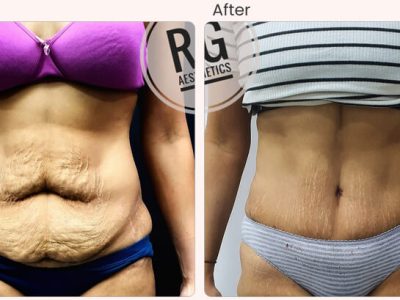 Tummy Tuck Surgery cost in Delhi - Dr Rajat Gupta