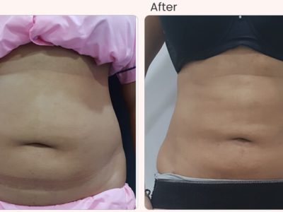 Liposuction Surgery Cost in Delhi - Dr Rajat Gupta