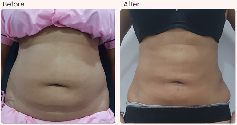 Liposuction Surgery Cost in Delhi - Dr Rajat Gupta