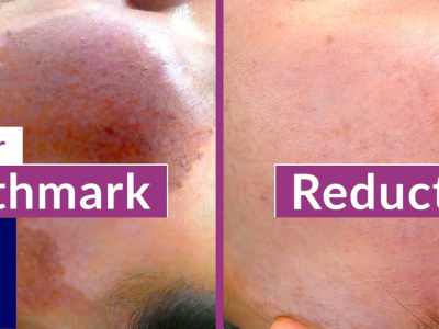 Professional Laser Birthmark Removal in Thane | DNA Royal Clinic.