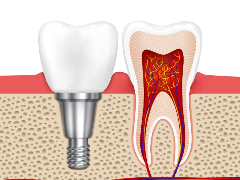 Dental Implants at White Dental Healthcare