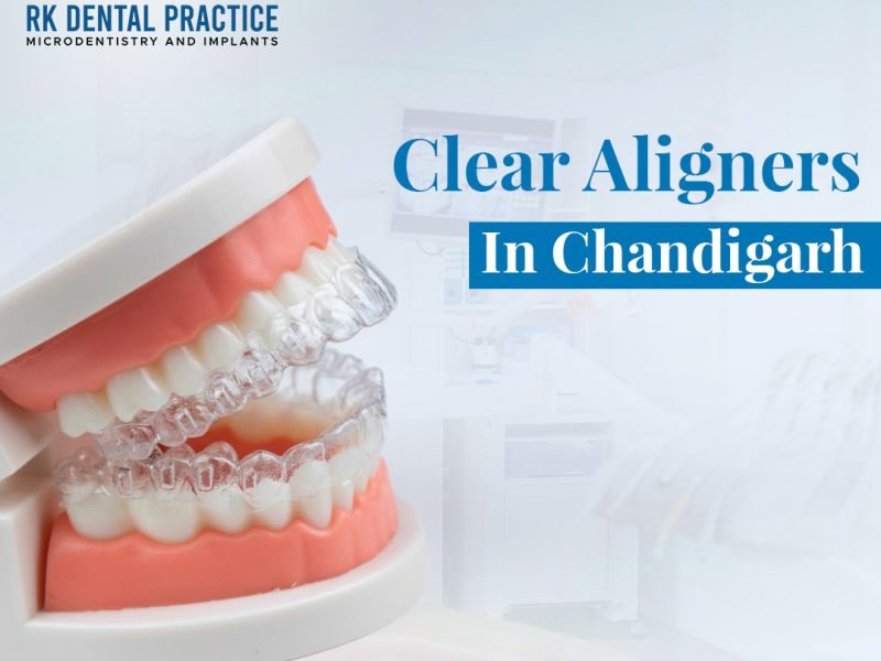Clear Aligners in Chandigarh for Invisible Teeth Straightening
