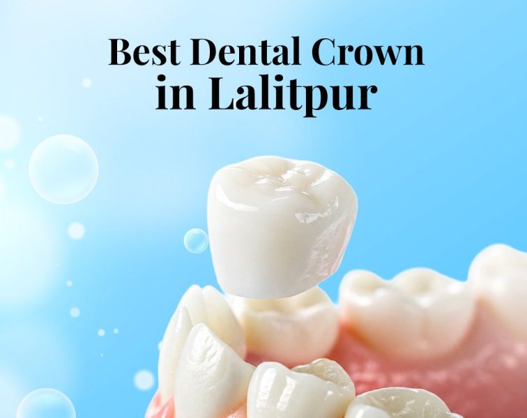 Best Dental Crown in Lalitpur