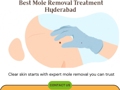 Best Mole Removal Treatment Hyderabad | Dr. Venus
