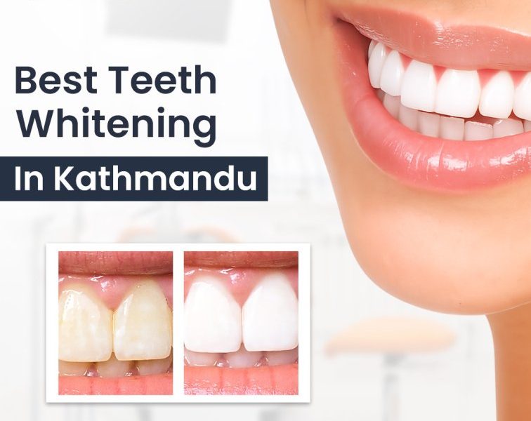 Best Teeth Whitening in Kathmandu