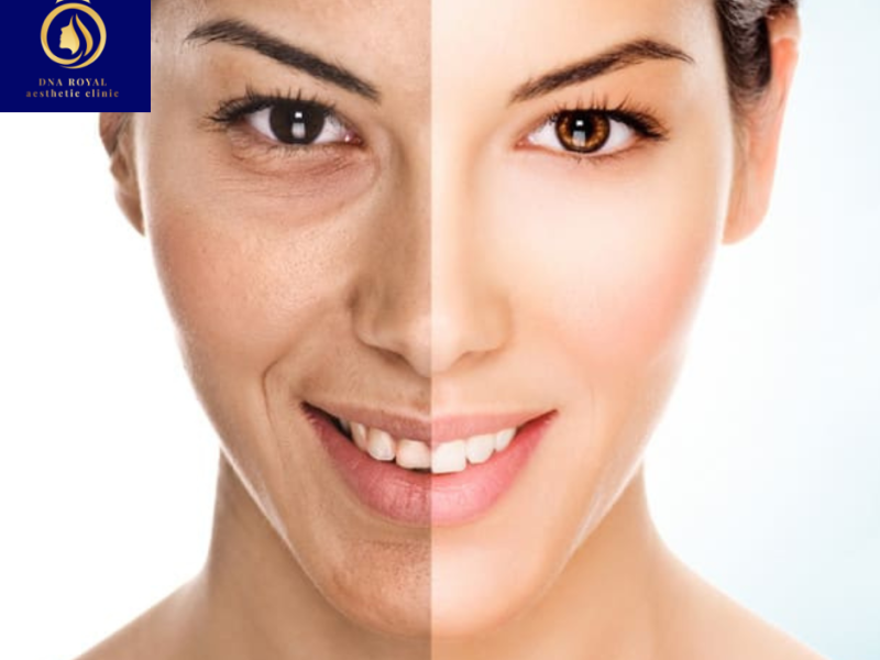Best Cosmelan Treatment in Thane | DNA Royal Skin Clinic.