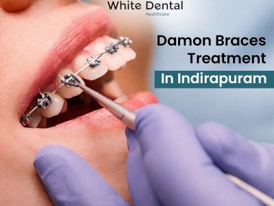 Damon Braces Treatment in Indirapuram for Perfect Smile