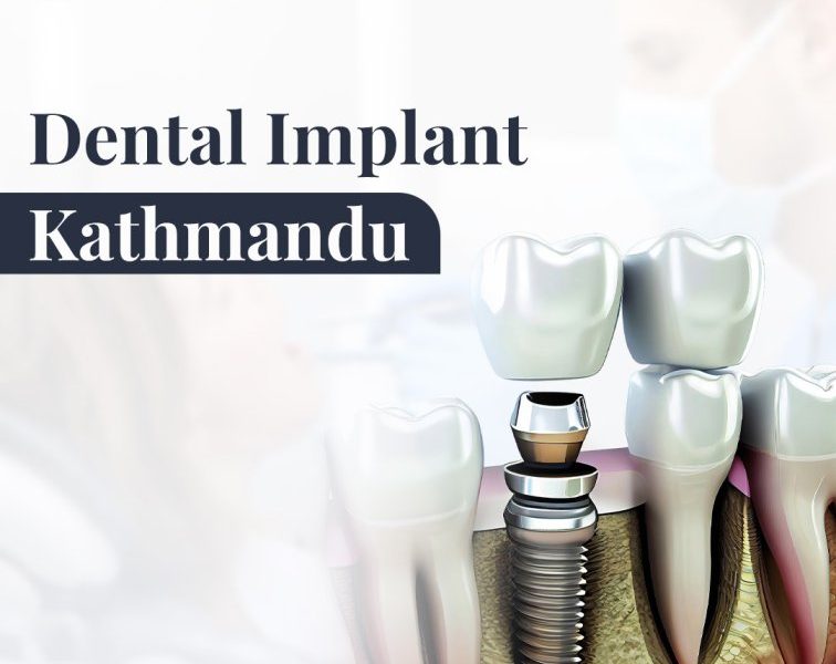Best Dental Implant Kathmandu