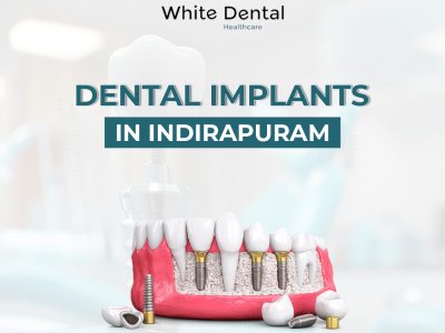 Dental Implants in Indirapuram for Healthy and Strong Teeth