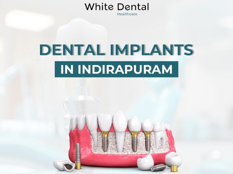 Dental Implants in Indirapuram for Healthy and Strong Teeth