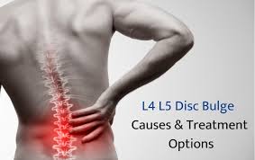 Advanced Disc Bulge Treatment in India – Effective Spine Care & Pain Relief Solutions