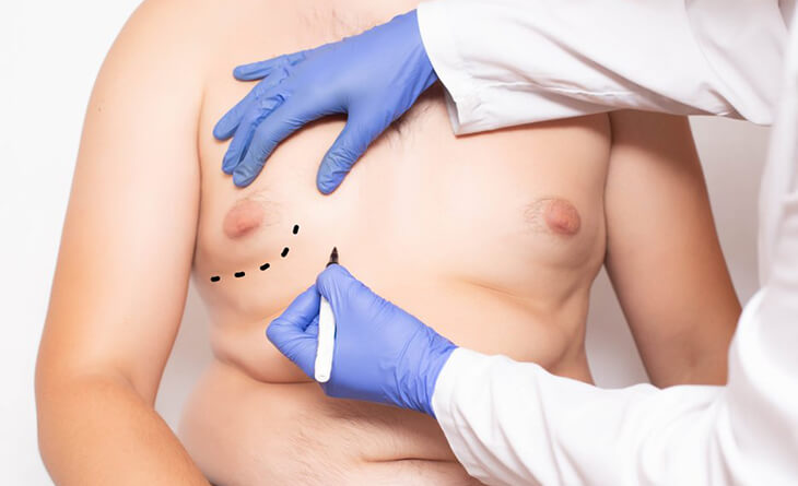 Gynecomastia and Liposuction Surgery: Do You Need Both?
