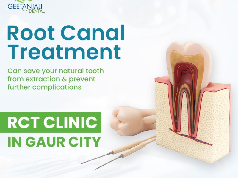 RCT Clinic in Gaur City for Painless Root Canal Treatments